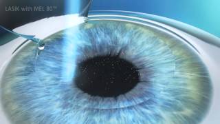 LASIK Verfahren  Augenlaserbehandlung Ablauf [upl. by Elleryt244]