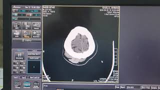 Scalp Heamatoma on CT Brain [upl. by Eeslehc]