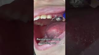 Remove the space maintainer baby teeth video tiktok trending dentist youtubeshorts shorts [upl. by Athey]