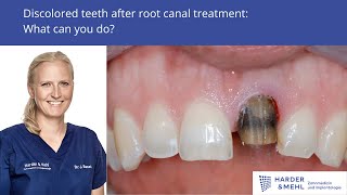 Discolored teeth after root canal treatment  what can you do [upl. by Rubens260]