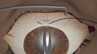 Strabismus surgery Traction [upl. by Atteyram]