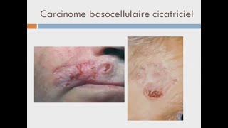 CARCINOME BASOCELLULAIRE [upl. by Airyk]