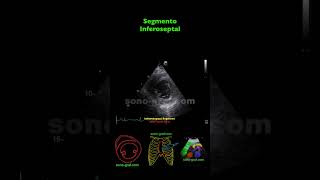 Ecocardiografía  Hipocinesia Inferolateral E Inferior [upl. by Lacagnia]