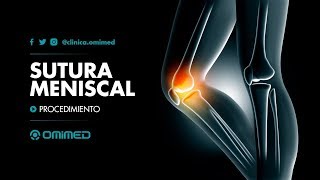 SUTURA MENISCAL [upl. by Eigram]