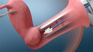 Pap and HPV Testing [upl. by Bouzoun]