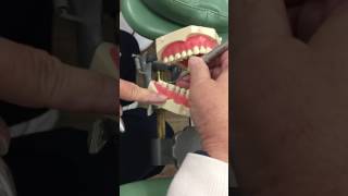 Instrumentation on Mandible with Universal Curettes part 1 [upl. by Adnirem]