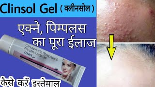 Clinsol Gel Review In Hindi  एक्ने पिम्पलस ऑयली स्किन की असरदार दवा [upl. by Claudell]