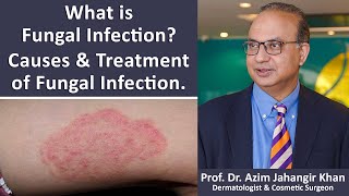 What is Fungal Infection Causes and Treatment of Fungal Infection  Prof Dr Azim Jahangir Khan [upl. by Nikola]