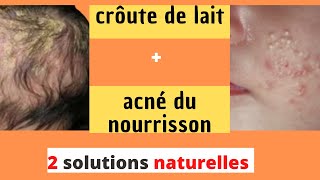 Comment éliminer les croûtes de lait et lacné du nourrisson Méthodes naturelles pour les éliminer [upl. by Petulia]