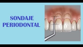 ¿Cómo se realiza el sondaje periodontal [upl. by Brendis69]