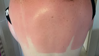 Satisfying sunburn peeling no sound [upl. by Yeoj]