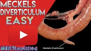 Meckels Diverticulum Made Easy [upl. by Rik]