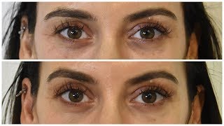 Augenbrauenlifting ohne OP  Entfernung der Augenringe by Dr Yildirim aesthetic Lounge [upl. by Eelidnarb]