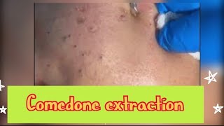 Comedone extraction White head extraction blackhead extraction [upl. by Tesler683]