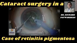 Cataract Surgery in a case of retinitis pigmentosa Dr Sourabh Patwardhan Live Cataract surgery [upl. by Adelheid]