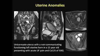 ISMRM MR Academy  Endometrial and Cervical Cancer [upl. by Leifer]