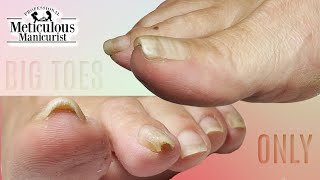 👣Big Toes Only  THICK Pincer Toenail Pedicure👣 [upl. by Branham44]