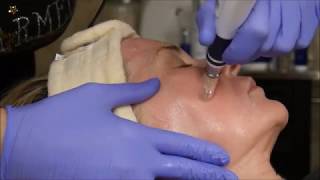 Microneedling with Brightalive ZO Skin Health [upl. by Moria]