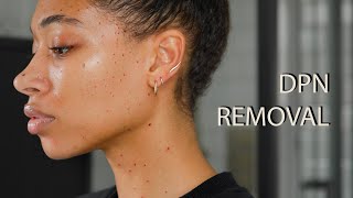 Dermatosis Papulosa Nigra DPN Removal [upl. by Crompton24]