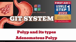 USMLE Step1 Polyp and its types Adenomatous Polyps from first aid step 1USMLEUrduHindi [upl. by Sacks]