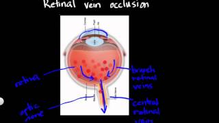 Retinal vein occlusion [upl. by Katharyn524]