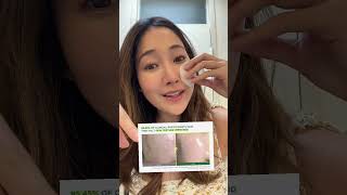 Korean skincare for acne amp textured skin kbeauty koreanskincare skincare acne skincareroutine [upl. by Carbrey624]