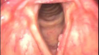 Carcinoma in Situ Larynx [upl. by Heid]