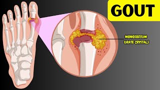 Understanding Gout  Causes Risk Factors Signs amp Symptoms Diagnosis amp Treatment [upl. by Noimad]