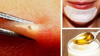 How to Remove Blackheads Around Mouth [upl. by Eiramana660]