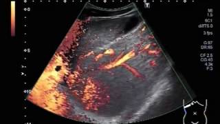 Ultrasound Video showing Hepatic parenchymal disease in a young patient of about 23 years [upl. by Ruprecht116]