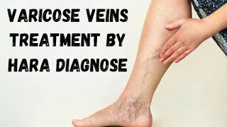 Varicose Veins Treatment by Hara Diagnose  9463086527  Gurnam Singh [upl. by Amihc]