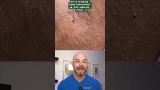 Derm reacts to armpit cyst removal dermreacts doctorreacts HS cyst [upl. by Chung]