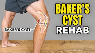 Bakers Cyst Treatment Rehab Exercises [upl. by Maller528]