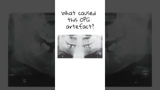 What caused this OPG artefact dentist dentalstudent dentistry dentistryknowledge nbde [upl. by Aholah]