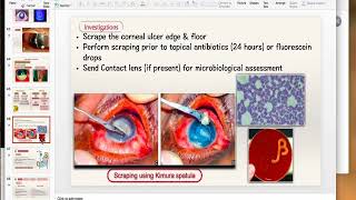 Bacterial Keratitis Part 2 [upl. by Atsylak911]