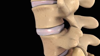 Back Pain Lumbar Disc Injury [upl. by Olatha]