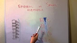 Epidural vs Spinal Anesthesia [upl. by Hanae]