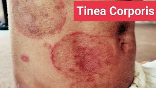 Understanding and Treating Tinea Corporis Expert Guide [upl. by Howland]