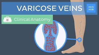 Varicose veins Definition causes symptoms and treatment  Kenhub [upl. by Niamert]