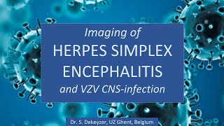 Imaging of Viral Encephalitis part 1 Herpes Simplex and Varicella Zoster [upl. by Lavotsirc]