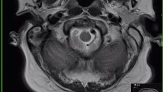 neuroradiology masterclass P6 [upl. by Gauldin577]