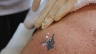 Laser Tattoo removal with QSwitched NdYAG [upl. by Accissej]