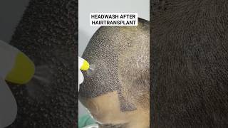 Head Wash After Hairtransplant hair hairtransplant hairlosstreatment ytshorts shorts [upl. by Nehtan]