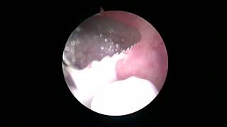 arthroscopy shoulder  old OCD lesion [upl. by Amoihc]