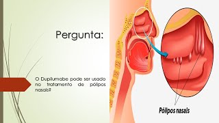 Pólipos Nasais  O Dupilumabe Dupixent pode ser usado no tratamento de Pólipos Nasais  DREA [upl. by Claman997]