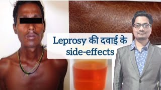 Leprosy की दवाइयों के sideeffects  Dapsone  Clofazimine  Rifampicin  Hansens disease leprosy [upl. by Gnoix]