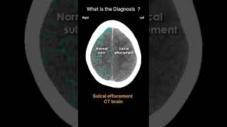 Sulcal effacement  CT brain Acute CT Brain Mass effect 76 radiologychannel007 [upl. by Aretse]