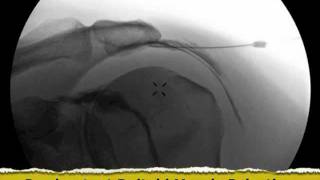 Inadvertent Deltoid Muscle Injection under Fluoroscopy  ThePainSourcecom [upl. by Syla]