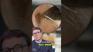 Using the Croc Forceps on a Long Piece of Ear Wax earwaxremoval earwaxclinic audiology [upl. by Chancey]