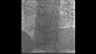 Stenting of the right coronary artery for inferior wall myocardial infarction Treatment [upl. by Nomma]